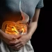 Cirurgia na Doença de Crohn: quando a ressecção intestinal é necessária
