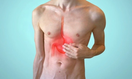 Cirurgia de Refluxo: quando o tratamento cirúrgico é necessário?