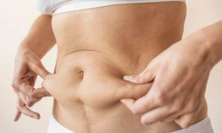 Cirurgia reparadora após a bariátrica: quando a remoção de pele em excesso é necessária