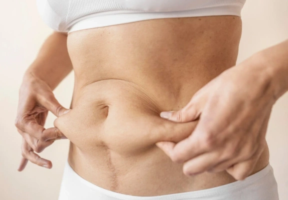 Cirurgia reparadora após a bariátrica: quando a remoção de pele em excesso é necessária