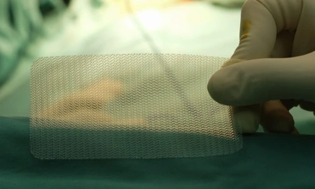 Tipos de tela para cirurgia de hérnia: qual a melhor opção?