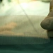 Tipos de tela para cirurgia de hérnia: qual a melhor opção?