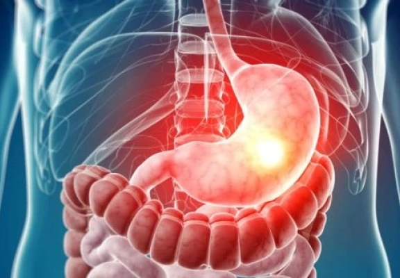 Gastroparesia: quando o estômago perde o ritmo e a digestão desacelera