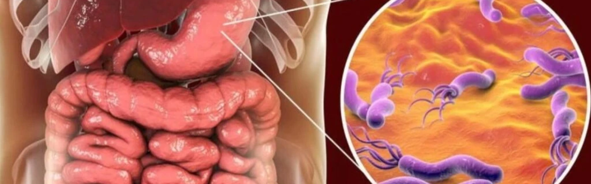 H. pylori e o câncer gástrico: entenda essa perigosa relação