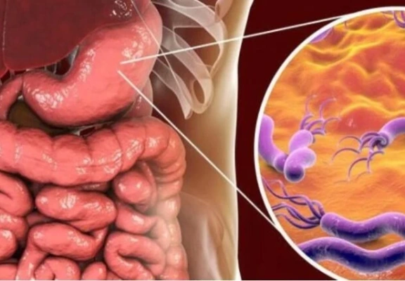 H. pylori e o câncer gástrico: entenda essa perigosa relação
