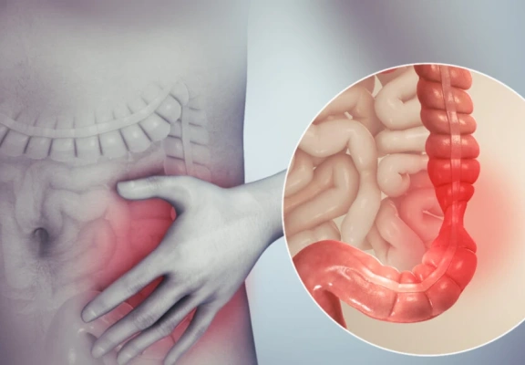 Síndrome do Intestino Irritável: quando o desconforto intestinal exige atenção médica